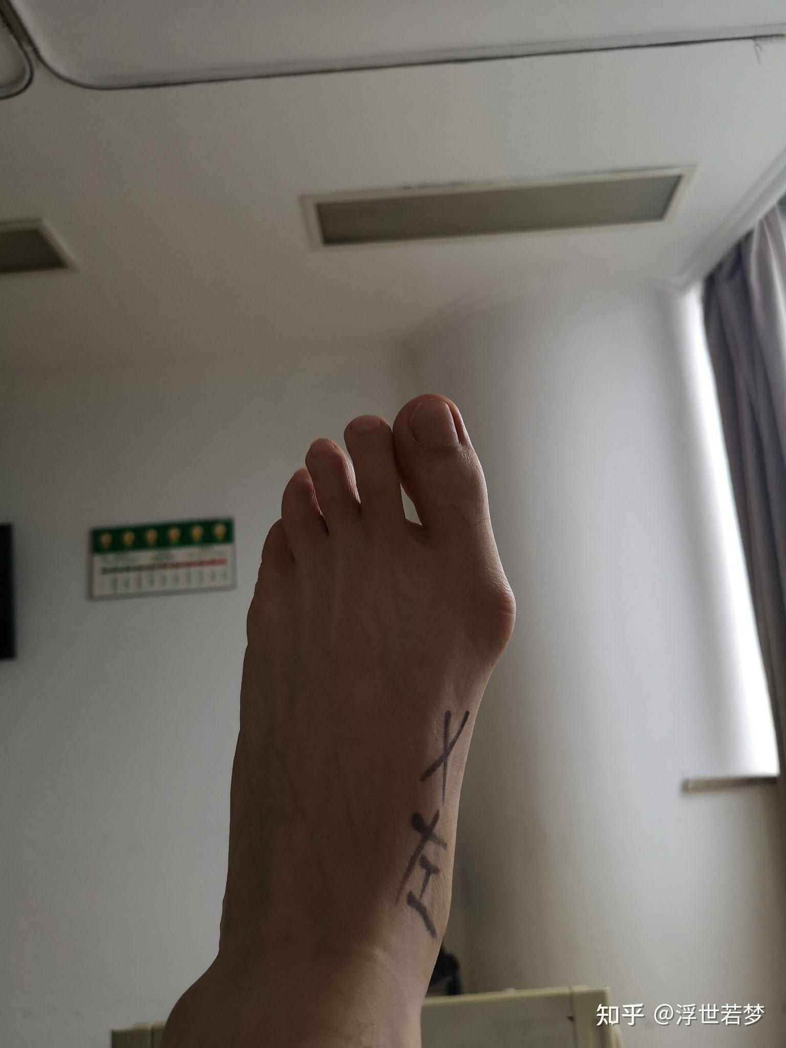 JJJ正式接受脚趾手术三个月后重新评估